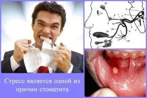 як лікувати стоматит у вагітних