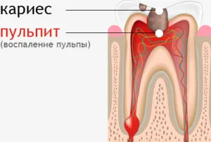 лікувати карієс не боляче