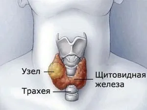 змішаний зоб щитовидної залози лікування народними засобами