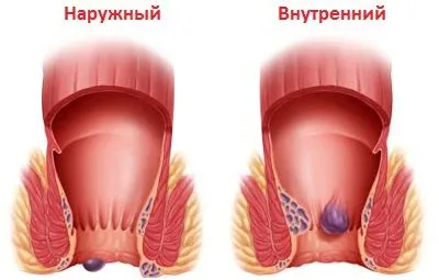 вилікувати геморой швидко