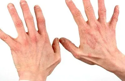 як лікувати хронічний дерматит