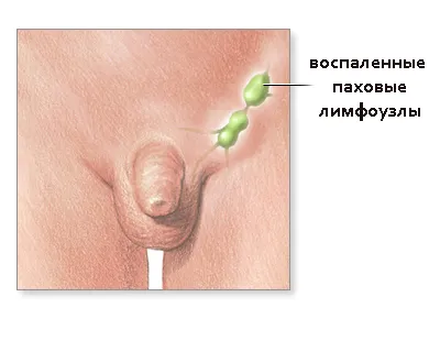 як лікувати лімфовузли в паху