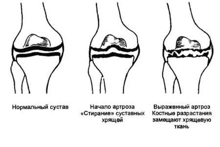 артроз ліктьовий суглоб лікування симптоми остеоартроз ступінь деформуючий народні засоби