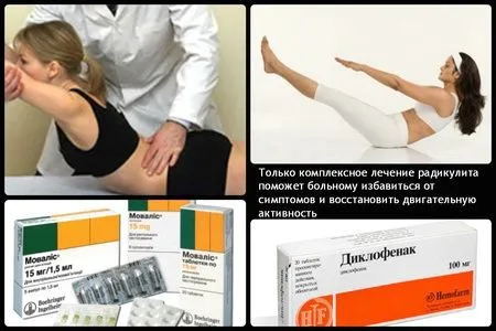 грудний радикуліт симптоми лікування