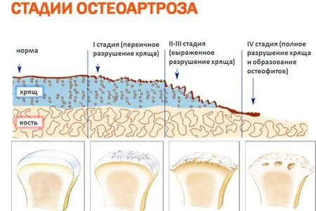 артроз ліктьовий суглоб лікування симптоми остеоартроз ступінь деформуючий народні засоби