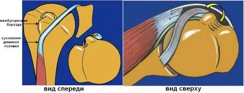 як лікувати розрив біцепса