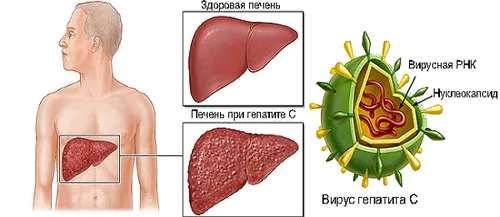 як збити температуру при цирозі печінки