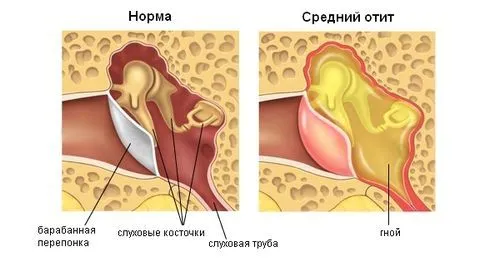 як лікувати вуха від грибка