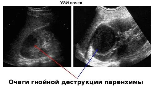 як лікувати мкд нирок