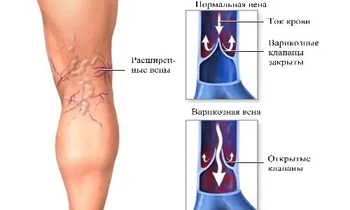лікують варикоз п'явками