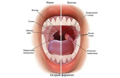 як лікувати горло якщо болять гланди