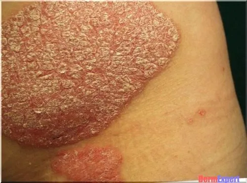 psoriasis vulgaris