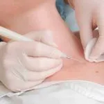 у кого лікувати папіломи