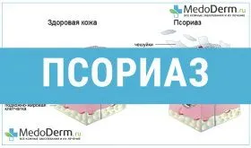 як лікувати інверсний псоріаз