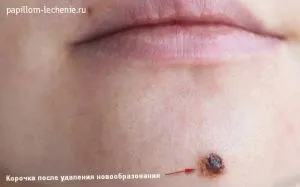 як лікувати папіломи на геніталіях в домашніх умовах