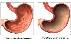 вилікував гастрит маслом обліпихи