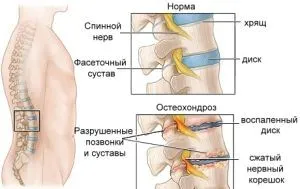радикуліт попереково крижовий симптоми