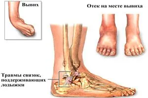 як вилікувати вивих ноги швидко