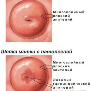 як лікувати папіломи в матці