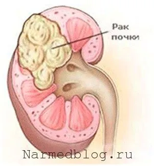 як вилікувати рак нирки народними засобами
