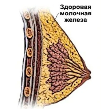 як вилікувати мастопатію без ліків