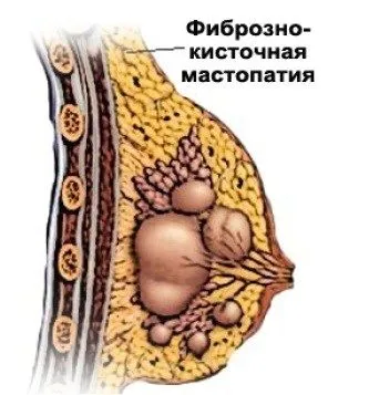 як вилікувати мастопатію без ліків