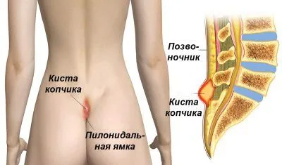 як лікувати фурункул на п'ятій точці