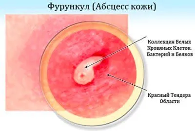 як лікувати фурункул на п'ятій точці