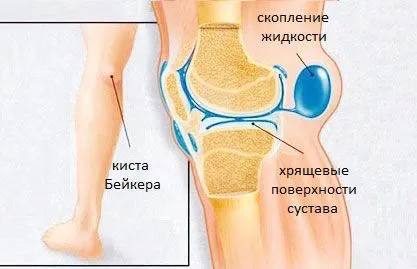 кіста Бейкера лікування в домашніх умовах