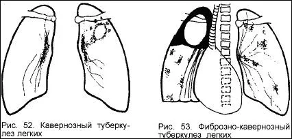 вогнищевий туберкульоз легені