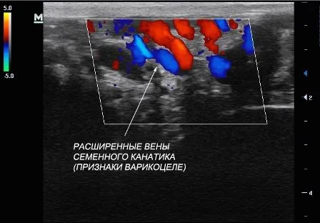 як лікувати варикоз 1 ступеня