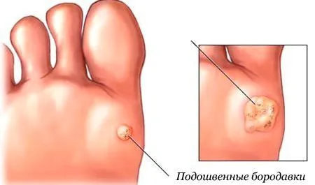бородавка