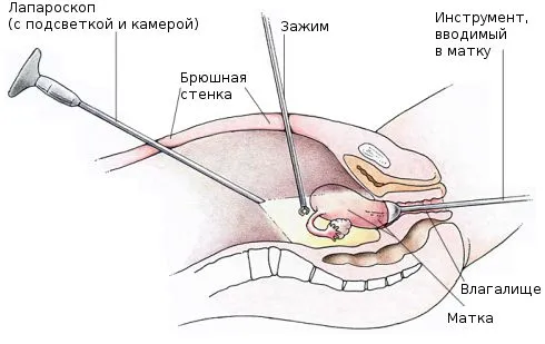 як лікувати ендометріоз після лапароскопії
