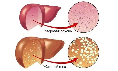 як лікувати мастопатію у чоловіків