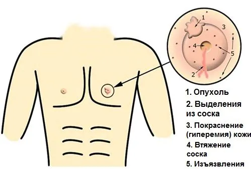 як лікувати мастопатію у чоловіків