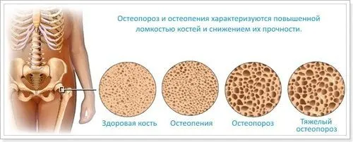 як лікувати остеопороз стегна