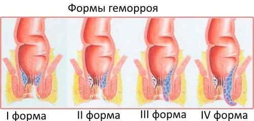як вилікувати геморой за допомогою огірка