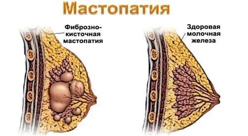 як вилікувати мастопатію без ліків