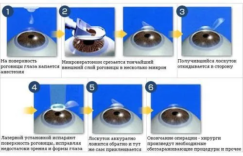 як лікувати астигматизм вправи