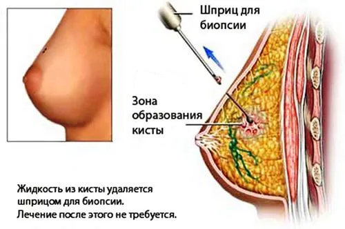 як лікувати кісту молочної залози