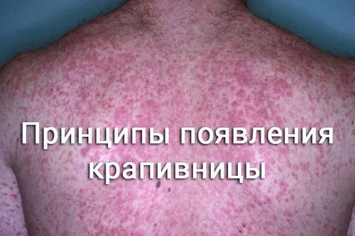 як лікувати хронічну кропив'янку