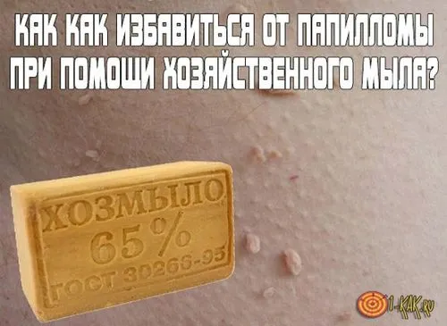 як вивести папіломи за допомогою господарського мила