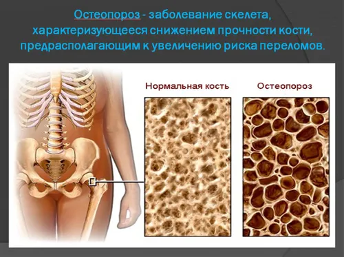 як лікувати остеопороз стегна