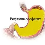 ніж лікувати температуру і біль в горлі