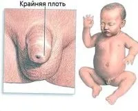 як лікувати баланопостит у дітей