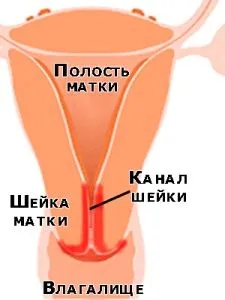кіста ендоцервікса