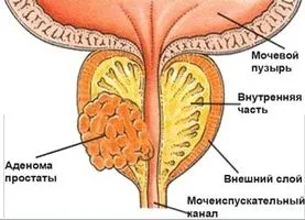 нове в лікуванні раку простати