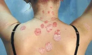 як лікувати загострення псоріазу