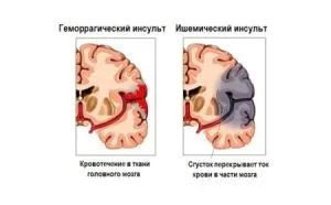 як лікувати інсульт права півкуля головного мозку