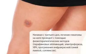 лікування гематоми на нозі після удару